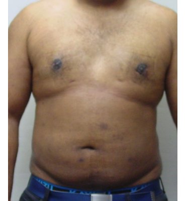 gynecomastio after